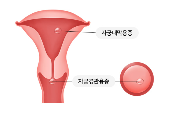 자궁내막용종 / 자궁경관용종 이미지