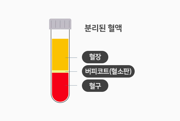 분리된 혈액 - 혈장, 버피코트(혈소판), 혈구